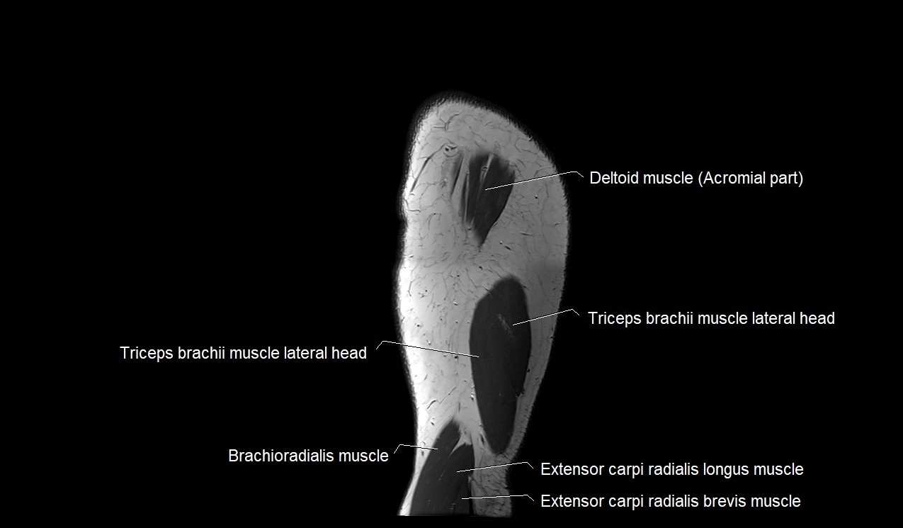 Upper arm (humerus ) saittal cross sectional anatomy 3T image 2.webp